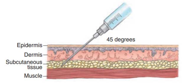 Picture showing the correct way to administer an subcutaneous injection