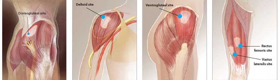 Intramuscular Route of Drug Administration: Picture of potential sites for IM injection