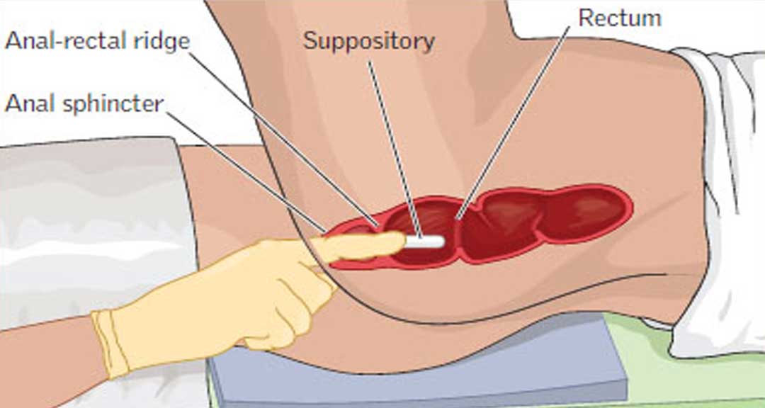 Featured image for Rectal Route of Drug Administration: Advantages and Disadvantages